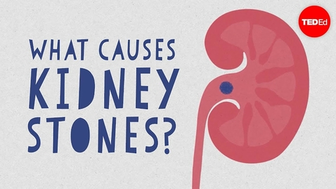 Thumbnail for HTHS 1101 F11-01 Kidney Stones Video with Questions