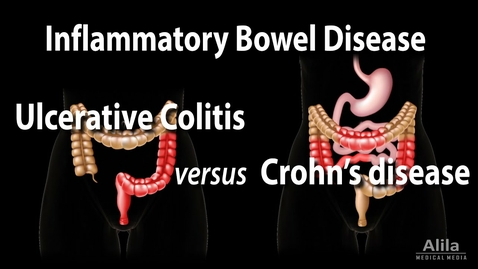 Thumbnail for HTHS 2231 Digestive: Ulcerative Colitis versus Crohn's Disease Video with Questions