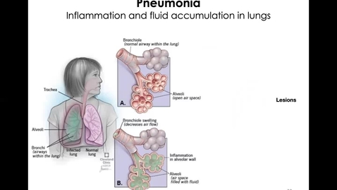 Thumbnail for MICR1153_11-10_Pneumonia_Twing