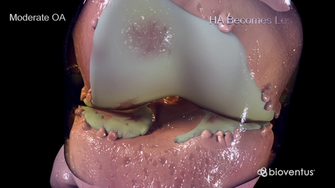 Thumbnail for entry HTHS 2231 Musculoskeletal: Osteoarthritis Video with Questions