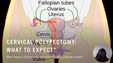 Thumbnail for NRSG6250WilkinsonACervicalPolypectomy