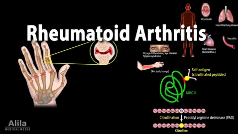 Thumbnail for entry HTHS 2231 Musculoskeletal: Rheumatoid Arthritis Video with Questions