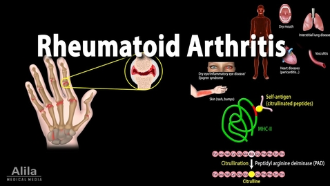 Thumbnail for HTHS 2231 Musculoskeletal: Rheumatoid Arthritis Video with Questions