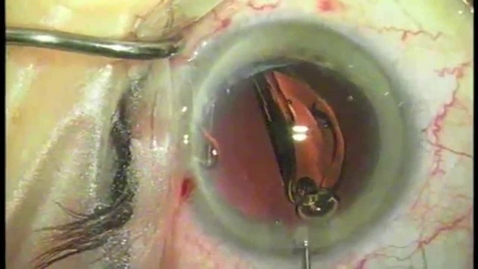 Thumbnail for HTHS 1101 F06-01 Cataract Surgery Video with Questions