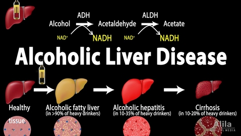 Thumbnail for entry HTHS 1101 F10-01 Alcoholic Liver Disease Video with Questions
