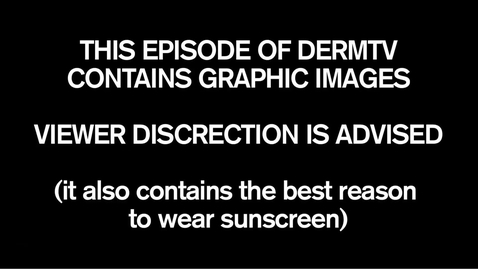 Thumbnail for HTHS 1101 F04-03 melanoma surgery