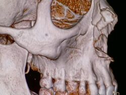 CU CT scan of human skull / Vermont, USA Stock Footage