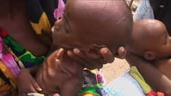 Thousands of children in malnourished state, many critical Instructional Video