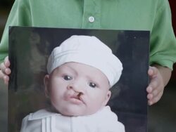 Slow motion of boy smiling with cleft lip. Stock Footage