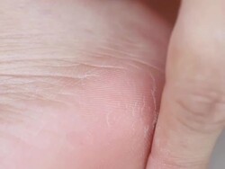Closeup view of cracks on a heel Stock Footage