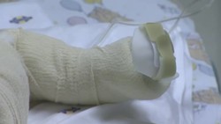 TODDLER IN CLONED SKIN TRANSPLANT AWAKE AND ALERT Instructional Video