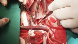 Heart surgeon perform VSD Closure Stock Footage