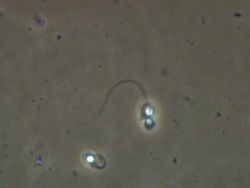 Deformed two headed Human sperm, Phase contrast Stock Footage