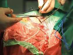 surgery Stock Footage