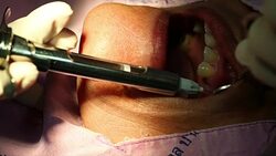 dental implant. Stock Footage