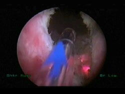 Laser prostate surgery. Endoscope image of a greenlight HPS laser inside the urethra of a patient undergoing a prostatectomy (removal of the prostate gland). The guide light is pink, the laser is yellow and dead cells are white.. Stock Footage