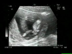Twins, ultrasound scan. Stock Footage