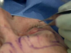 Facelift operation, clip 21 of 24. The surgeon has removed a flap of skin from the eyelid and is now sewing the two edges together, which will give a tighter appearance. This is the blepharoplasty stage of the operation Stock Footage