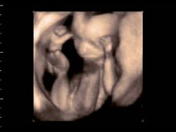 Foetus with its arms in front of its face, 4D ultrasound scan.. Stock Footage