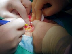 insicion with laser scalpel Stock Footage