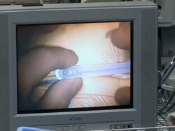 CU ZI ZO Monitor showing  doctor marking for surgery  /  Little Rock, Arkansas, USA Stock Footage