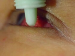 heal blood clot on eye Stock Footage