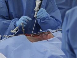 Surgery, surgeon, surgical, health care, medicine, medical, hospital, doctor. Stock Footage