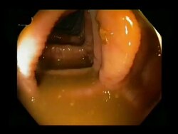 Healthy human colon, endoscope view. The colon, or large intestine, is the final part of the digestive system.. Stock Footage