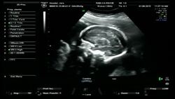 Pregnant 4D ultrasound Stock Footage