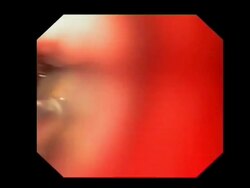 Stomach cancer biopsy, endoscope view. This is an intestinal type adenocarcinoma, a cancer of glandular tissue. The endoscope claw takes a small sample of the cancer for tests.. Stock Footage