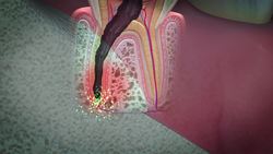 Root canal procedure Instructional Video