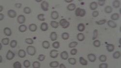 Abnormal red blood cells under microscope 1000X Stock Footage