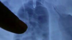 Doctors Examining X-Ray Image On A Tablet Stock Footage