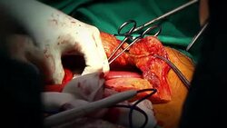 surgery operation Stock Footage