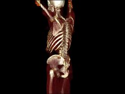 3D CT scan showing breast metastasis in skeleton of 52 year old woman with ductal carcinoma of the breast.  The cancer has spread (metastasised) to the bones. The CT scan shows diffuse blastic and lytic lesions throughout the skeleton. There are irregular Stock Footage