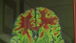 VOICED : Hard hits and head trauma News Clip