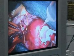 CU ZI Monitor showing doctors doing childs heart surgery  /  Little Rock, Arkansas, USA Stock Footage