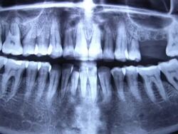 Dental X-Ray Stock Footage