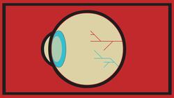 TED-Ed: A curable condition that causes blindness - Andrew Bastawrous Instructional Video