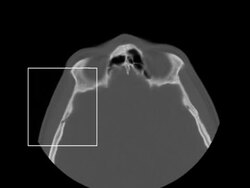 Head and Nose MINI CT Scan Stock Footage