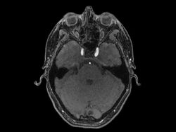 Axial MRI Scan Of Human Brain Stock Footage