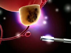 Threrapy to Treat Prostate Cancer Being Tested News Clip