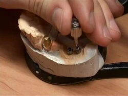 dental implants Stock Footage