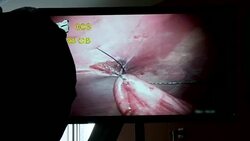 Gastric surgery on great dane Stock Footage