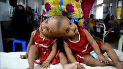 CLEAN : Bangladeshi twins born joined at skull to undergo surgery News Clip
