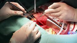 Heart surgeon suture Anastomosis Stock Footage