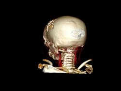 Skull Operation Stock Footage