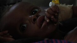 Doctors treat malnourished children at camp for drought victims News Clip