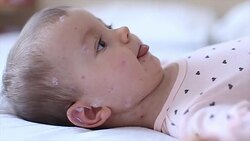 Crying baby girl with measles Stock Footage