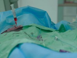 Vascular surgery. Stock Footage